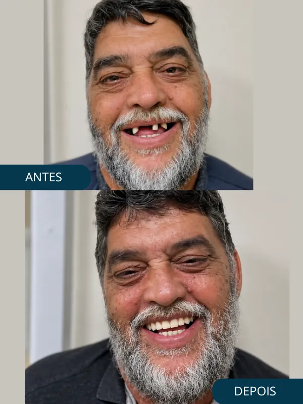 Antes da prótese protocolo — Odonto Help Canoas