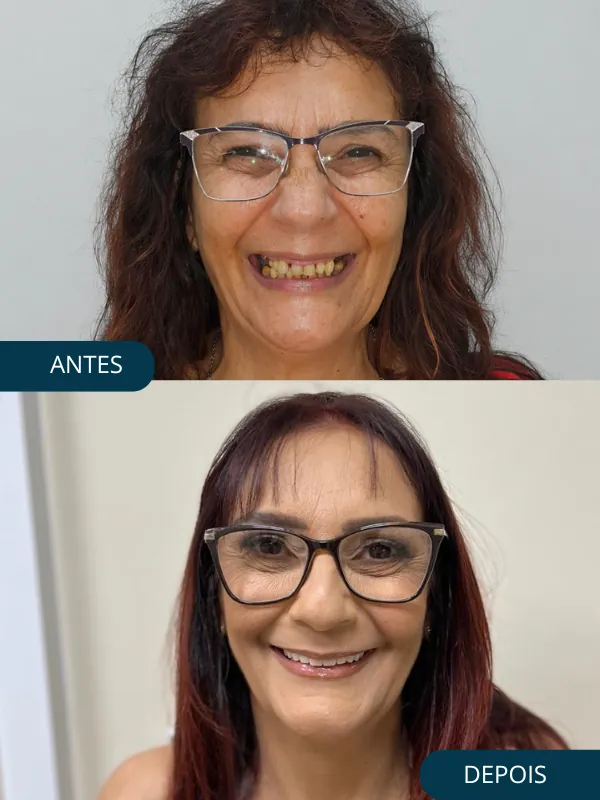 Depois da prótese protocolo — Odonto Help Canoas